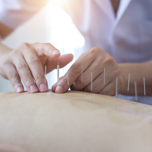 Acupuncture therapy for Pain relief